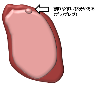 胸膜癒着術の画像