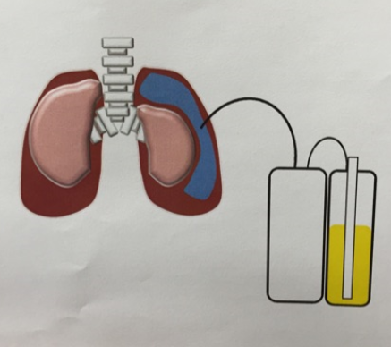 肺気胸のドレーン手術の画像