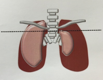 肺気胸の高度の治療方法の画像