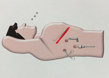 開胸手術の画像