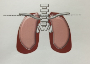 肺気胸の軽度の治療方法の画像